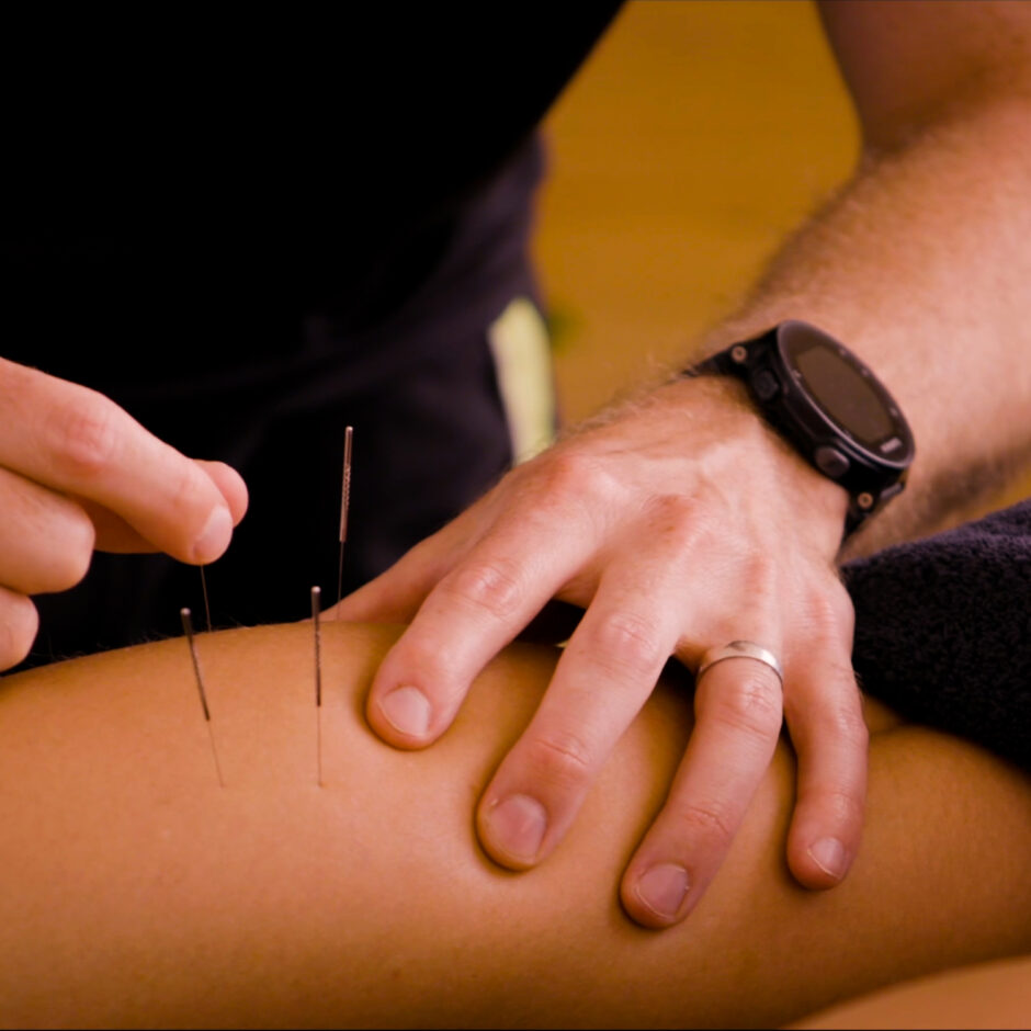 Dry needling as part of treatment for an injury.