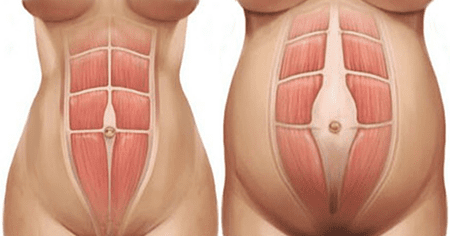 Rectus diastasis diagram showing separation of rectus abdominis muscles during pregnancy