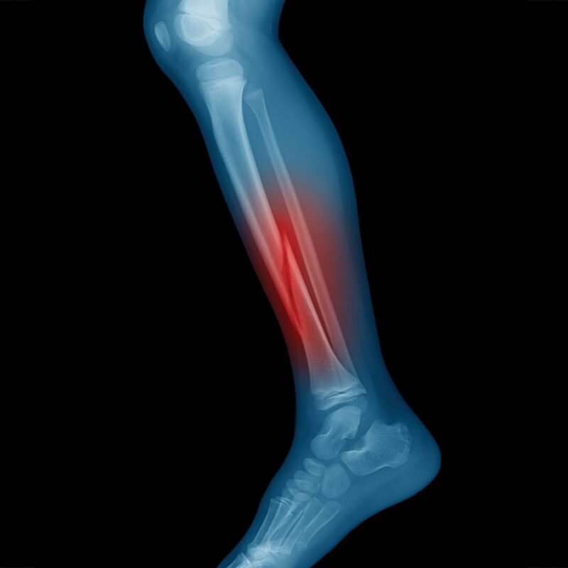 Illustration of tibia showing stress fracture area with highlighted pain zone