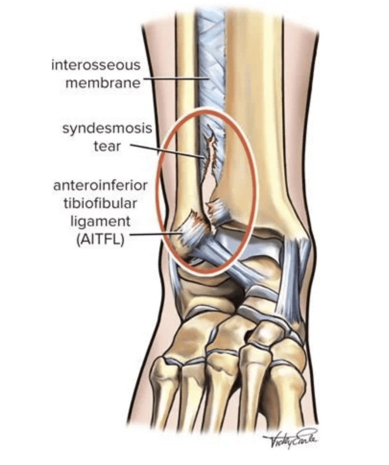Diagram showing syndesmosis tear in a high ankle sprain
